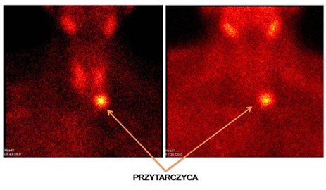 Przytarczyca przytarczyca